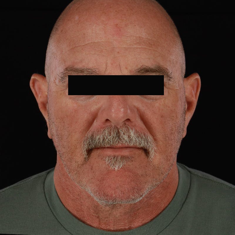 Neck Lift Before & After Gallery - Patient 135977 - Image 6