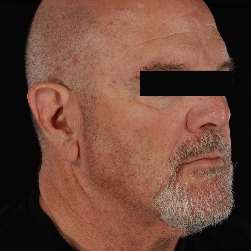 Neck Lift Before & After Gallery - Patient 135977 - Image 7