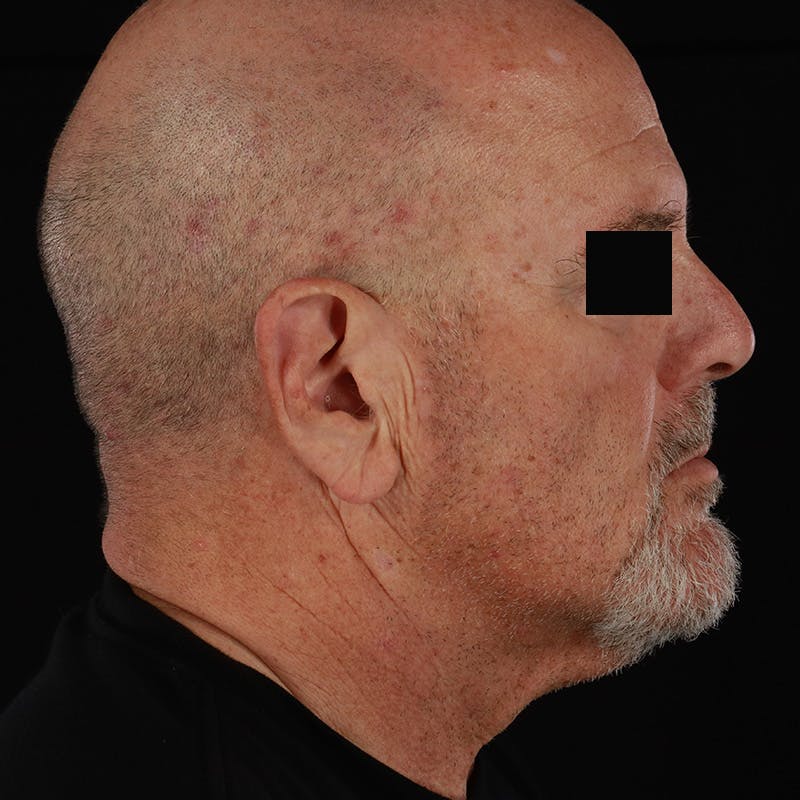 Neck Lift Before & After Gallery - Patient 135977 - Image 9