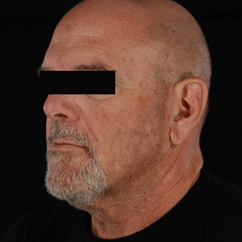Neck Lift Before & After Gallery - Patient 135977 - Image 3