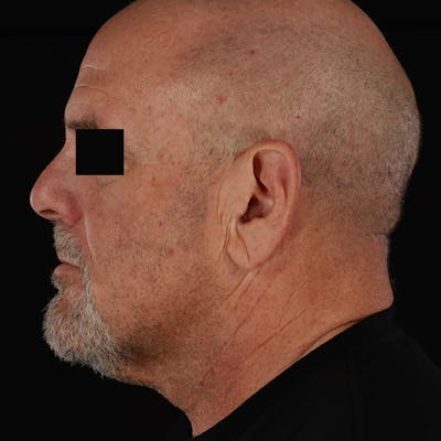 Neck Lift Before & After Gallery - Patient 135977 - Image 1