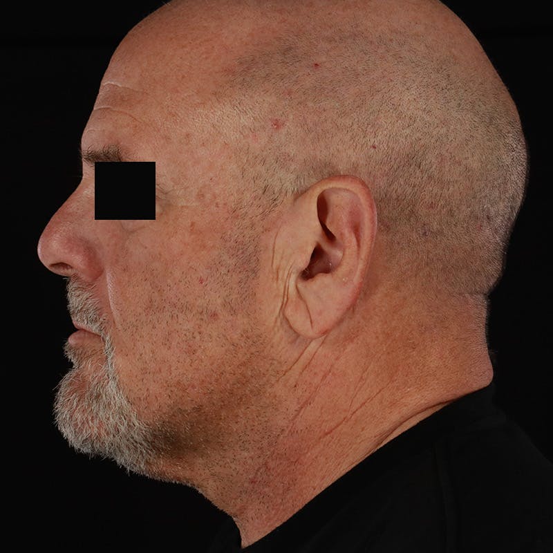 Neck Lift Before & After Gallery - Patient 135977 - Image 1