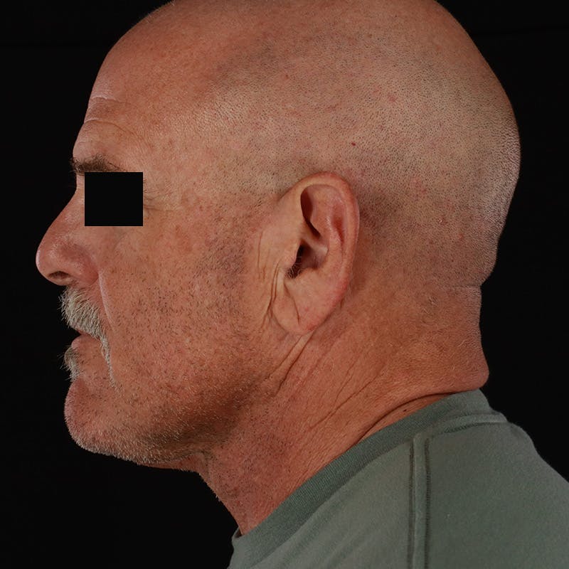 Neck Lift Before & After Gallery - Patient 135977 - Image 2