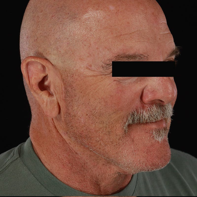 Neck Lift Before & After Gallery - Patient 135977 - Image 8