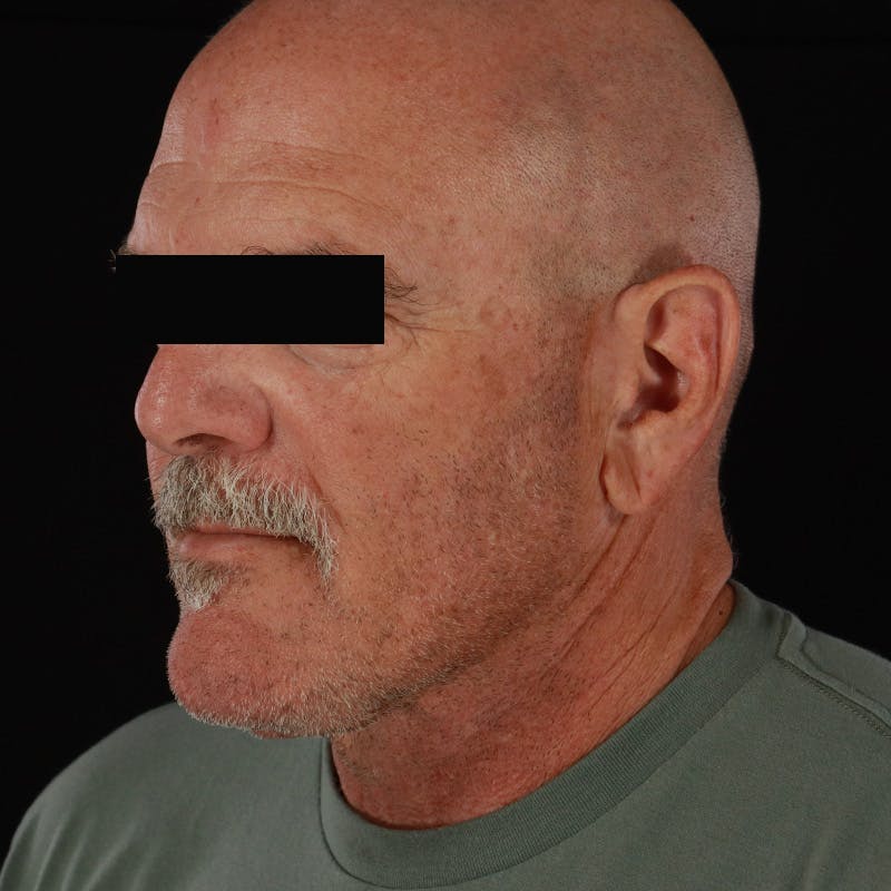 Neck Lift Before & After Gallery - Patient 135977 - Image 4
