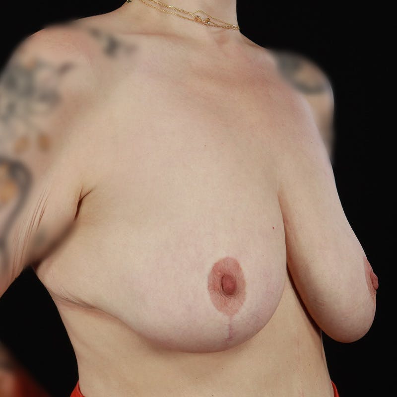 Breast Lift with Auto Augmentation Before & After Gallery - Patient 229914 - Image 5