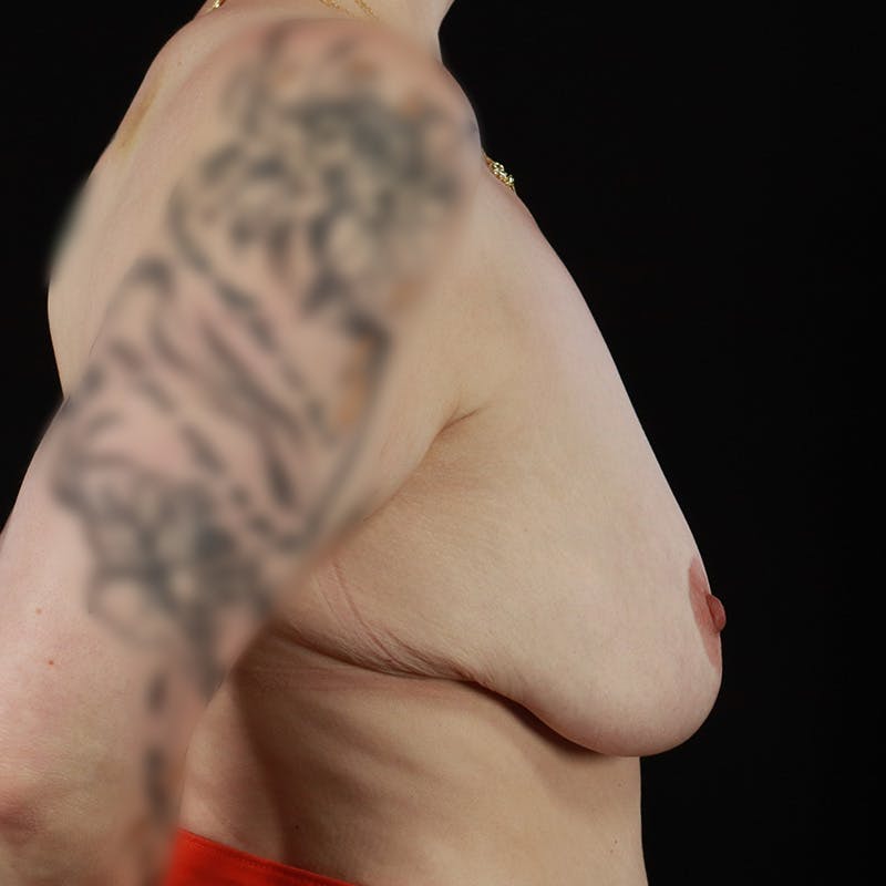 Breast Lift with Auto Augmentation Before & After Gallery - Patient 229914 - Image 7