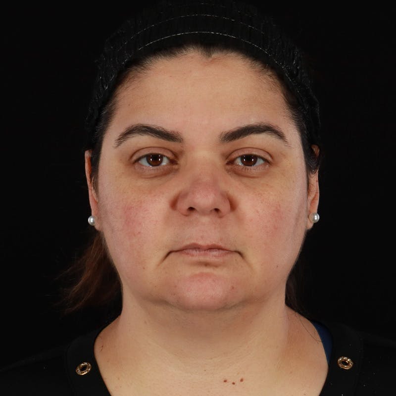 Facelift Before & After Gallery - Patient 610602 - Image 1