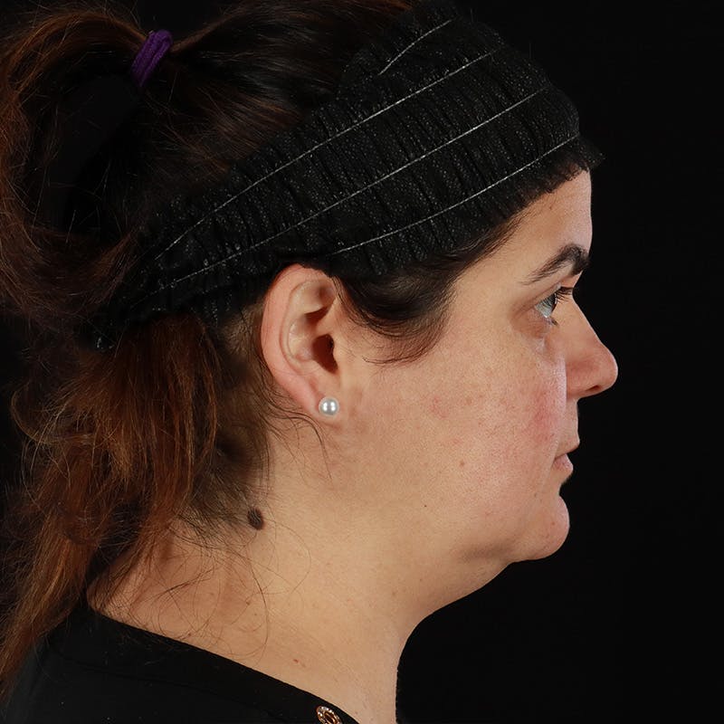 Facelift Before & After Gallery - Patient 610602 - Image 5