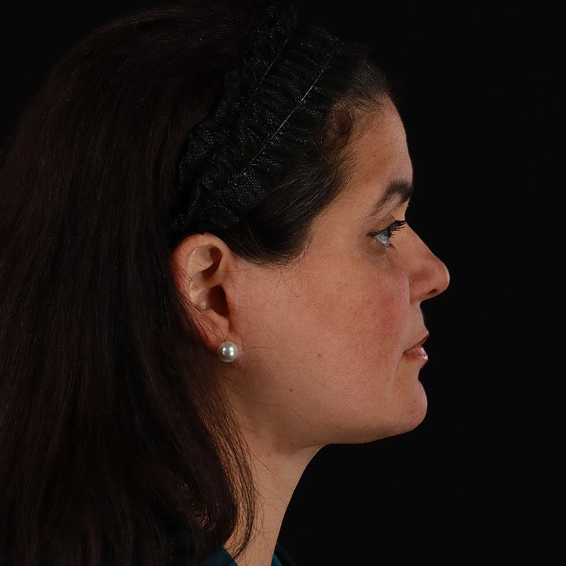 Facelift Before & After Gallery - Patient 610602 - Image 6