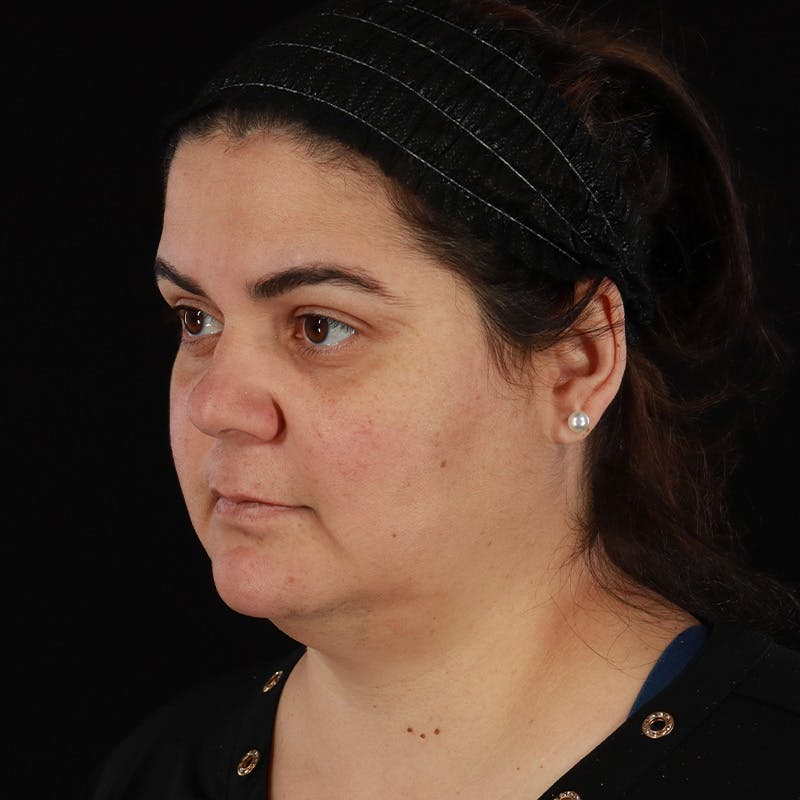 Facelift Before & After Gallery - Patient 610602 - Image 7