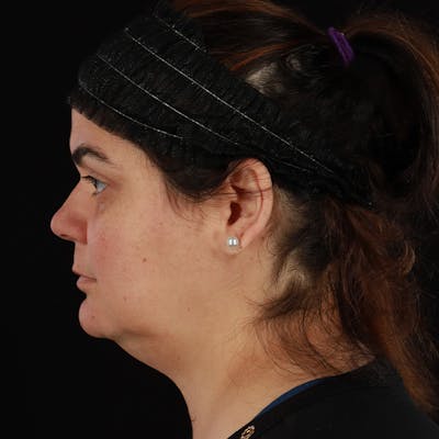 Neck Lift Before & After Gallery - Patient 108819 - Image 1