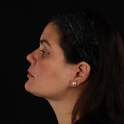 Neck Lift Before & After Gallery - Patient 108819 - Image 2