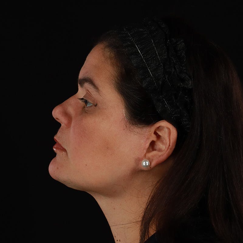 Facelift Before & After Gallery - Patient 610602 - Image 10