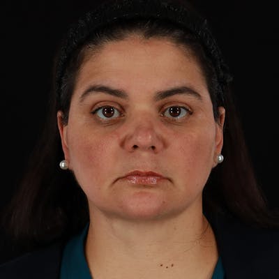 Facelift Before & After Gallery - Patient 610602 - Image 2