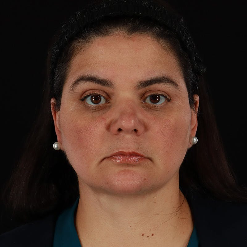 Facelift Before & After Gallery - Patient 610602 - Image 2
