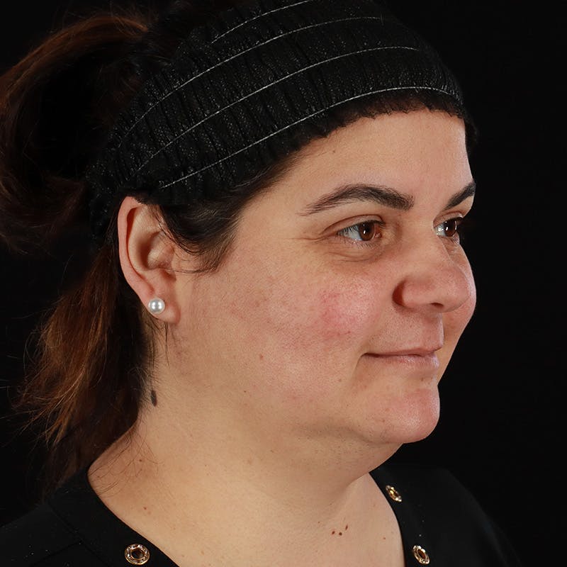 Facelift Before & After Gallery - Patient 610602 - Image 3