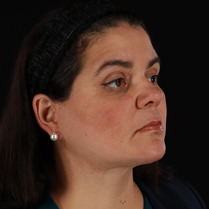 Facelift Before & After Gallery - Patient 610602 - Image 4