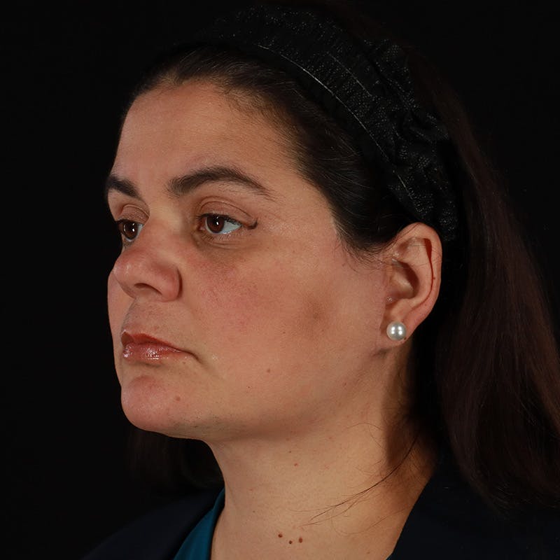 Facelift Before & After Gallery - Patient 610602 - Image 8