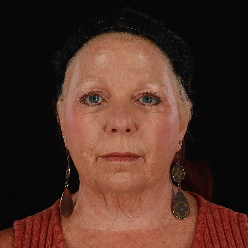 Facelift Before & After Gallery - Patient 478394 - Image 1