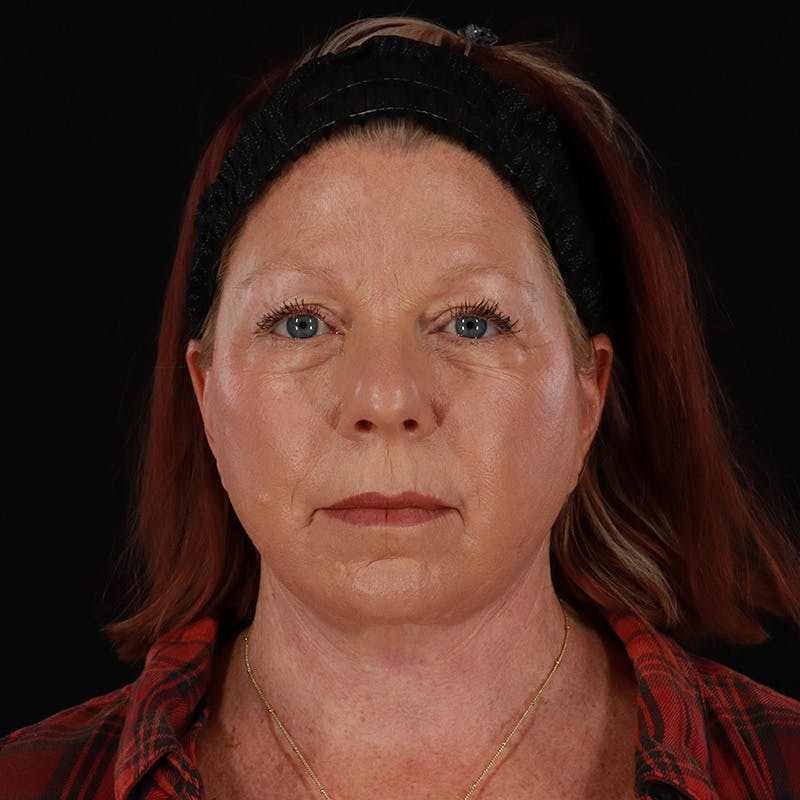 Facelift Before & After Gallery - Patient 478394 - Image 2