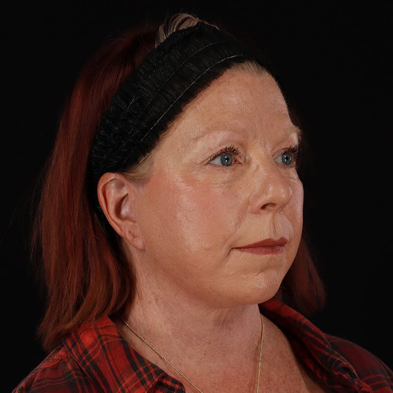 Facelift Before & After Gallery - Patient 478394 - Image 4