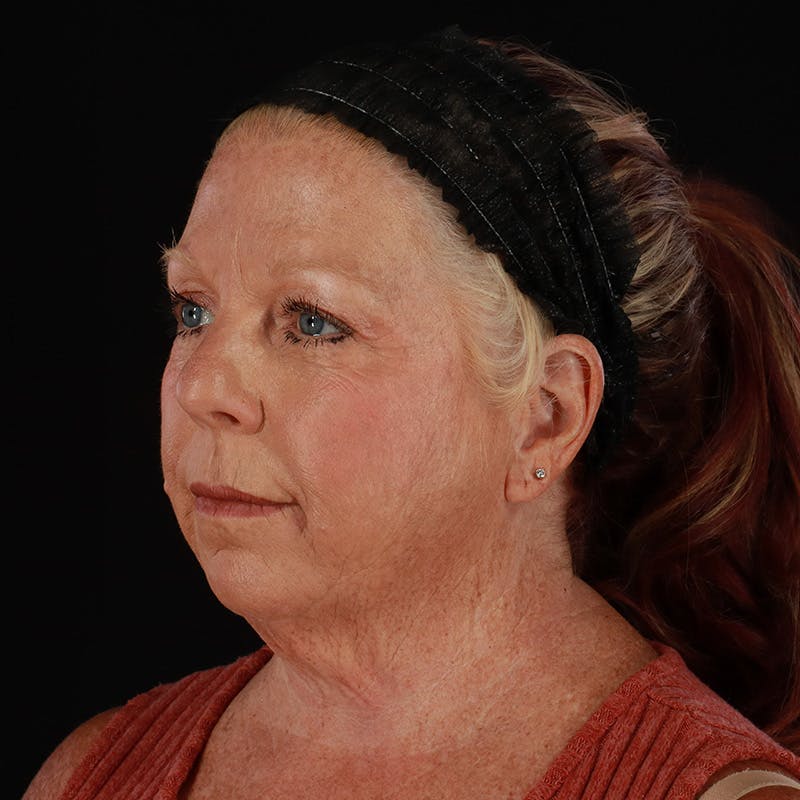 Facelift Before & After Gallery - Patient 478394 - Image 7