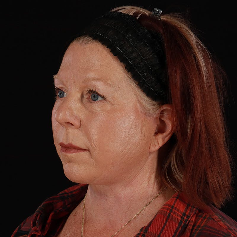Facelift Before & After Gallery - Patient 478394 - Image 8