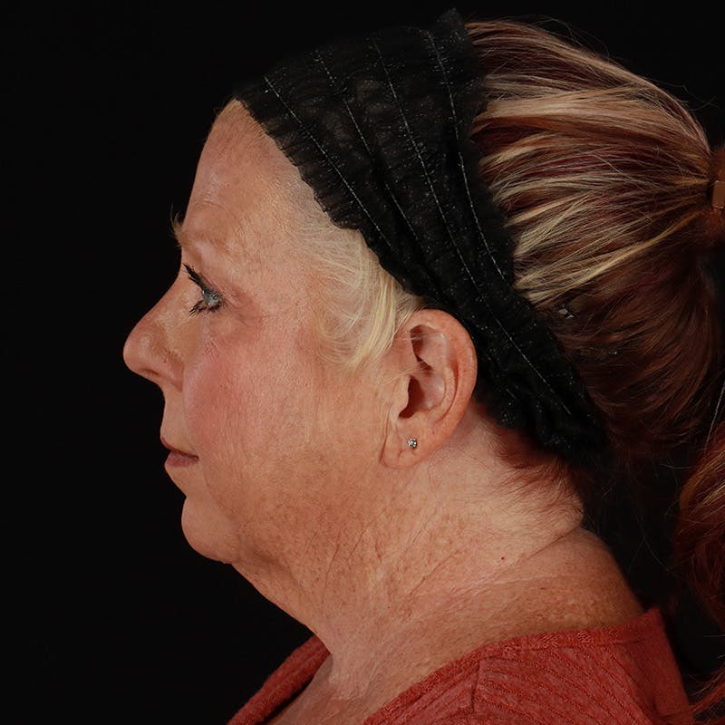 Facelift Before & After Gallery - Patient 478394 - Image 9