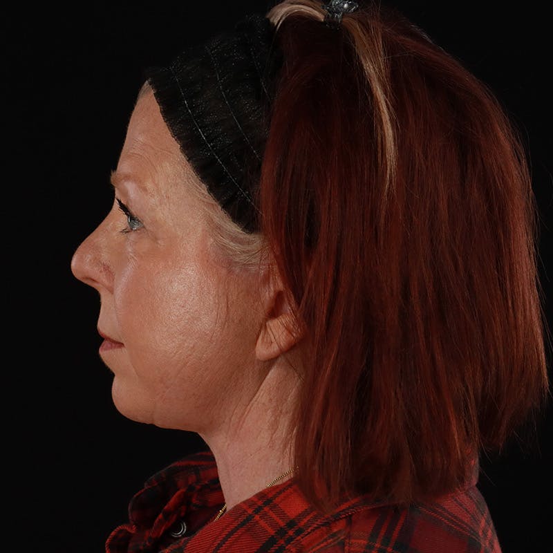 Facelift Before & After Gallery - Patient 478394 - Image 10