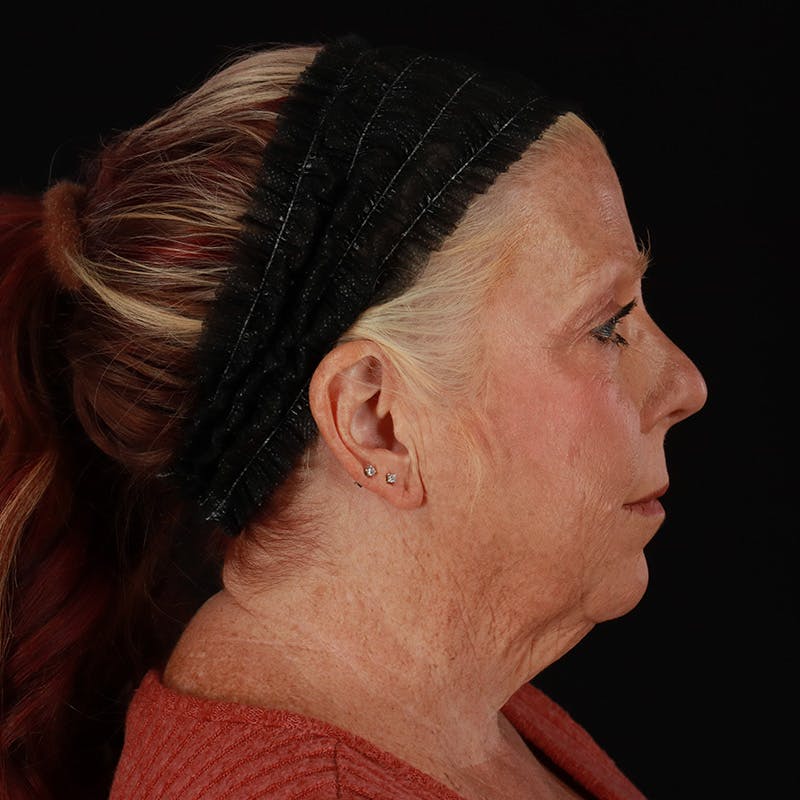 Facelift Before & After Gallery - Patient 478394 - Image 5