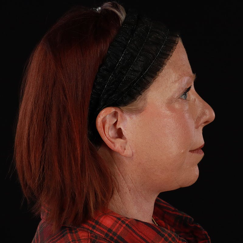Facelift Before & After Gallery - Patient 478394 - Image 6