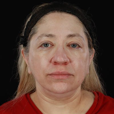 Facelift Before & After Gallery - Patient 108377 - Image 1