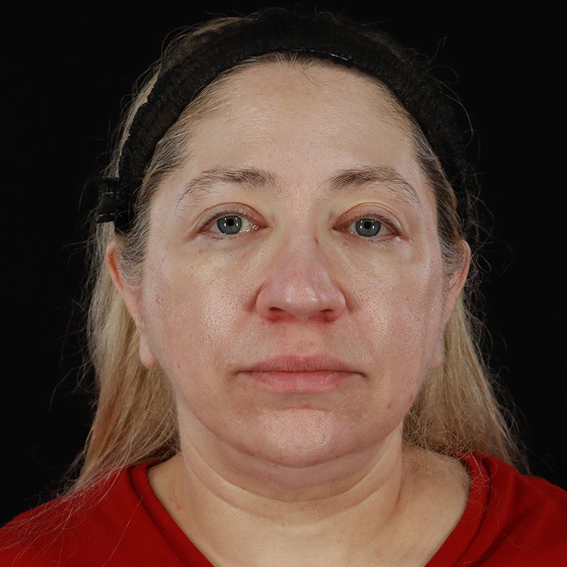 Neck Lift Before & After Gallery - Patient 395456 - Image 3