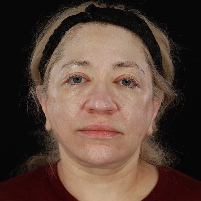Neck Lift Before & After Gallery - Patient 395456 - Image 4