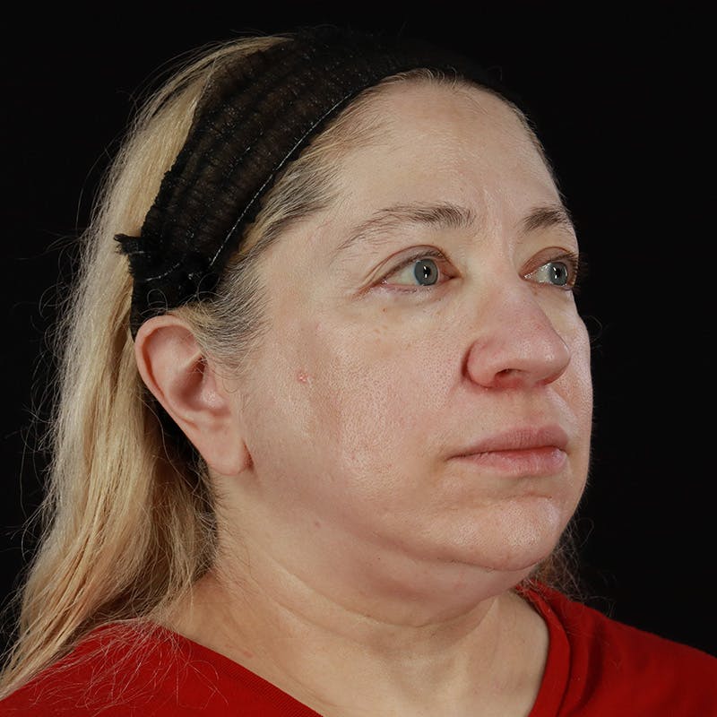 Neck Lift Before & After Gallery - Patient 395456 - Image 5