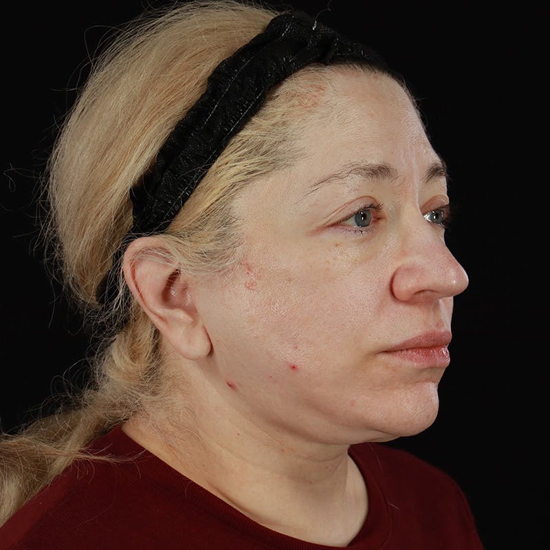 Neck Lift Before & After Gallery - Patient 395456 - Image 6