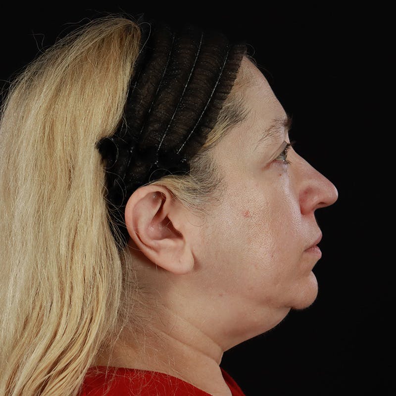 Neck Lift Before & After Gallery - Patient 395456 - Image 7
