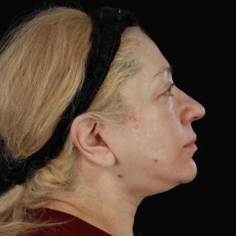 Neck Lift Before & After Gallery - Patient 395456 - Image 8