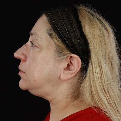 Neck Lift Before & After Gallery - Patient 395456 - Image 1