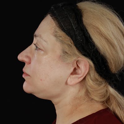 Neck Lift Before & After Gallery - Patient 395456 - Image 2