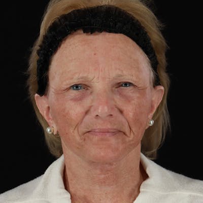 Facelift Before & After Gallery - Patient 381567 - Image 2