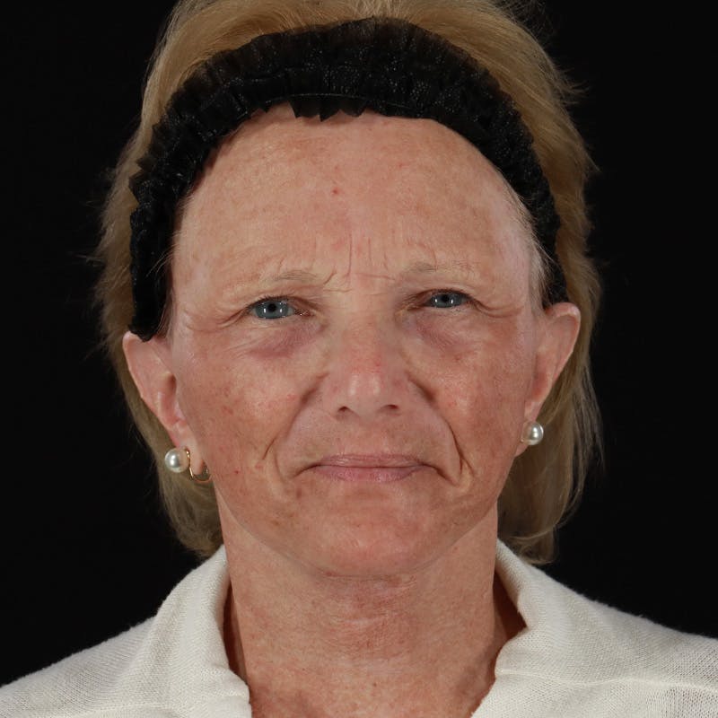 Facelift Before & After Gallery - Patient 381567 - Image 2
