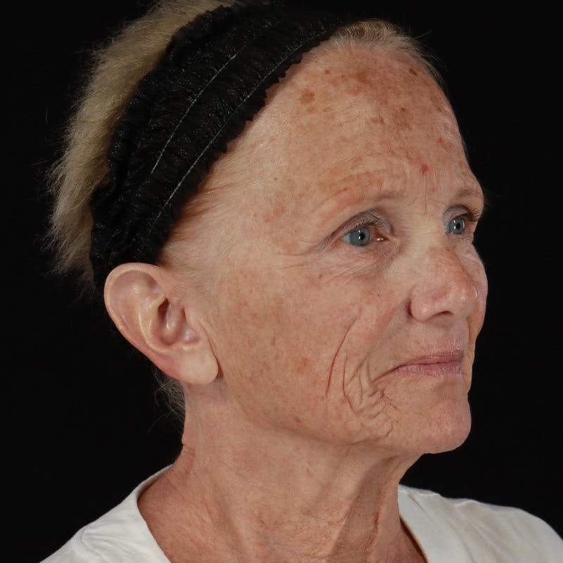 Facelift Before & After Gallery - Patient 381567 - Image 3