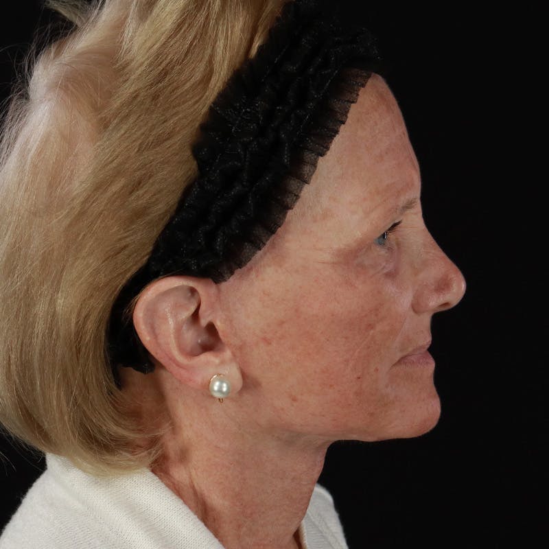 Facelift Before & After Gallery - Patient 381567 - Image 6