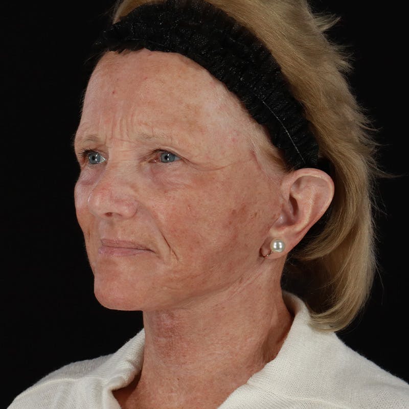 Facelift Before & After Gallery - Patient 381567 - Image 8