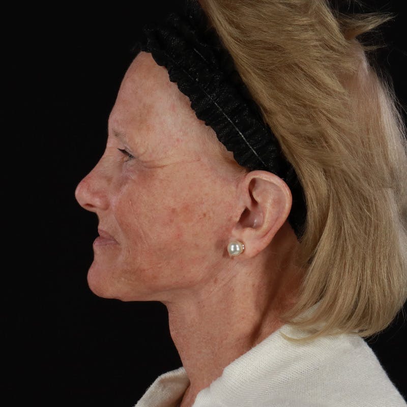 Facelift Before & After Gallery - Patient 381567 - Image 10
