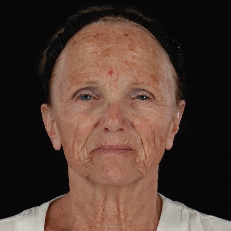 Facelift Before & After Gallery - Patient 381567 - Image 1