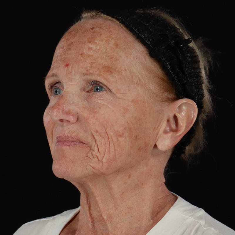 Facelift Before & After Gallery - Patient 381567 - Image 7
