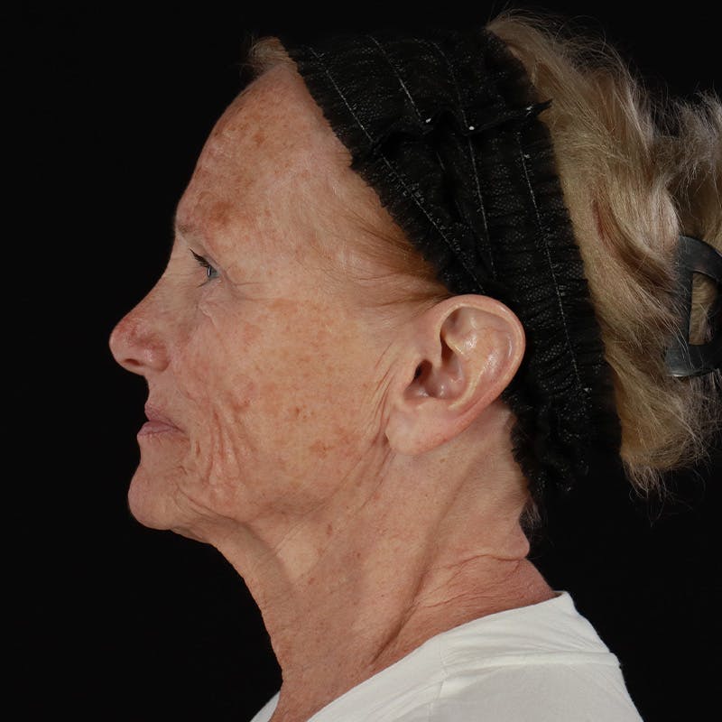 Facelift Before & After Gallery - Patient 381567 - Image 9